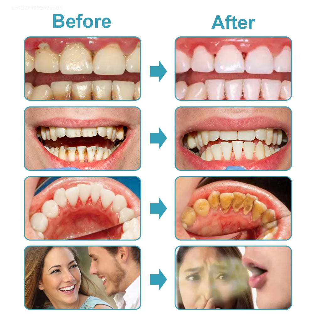 Tartar Remover Electric Powerful Ultrasonic Plaque Stain Remover for Teeth 2 In1 Ultrasonic Tooth Cleaning and Oral Irrigator