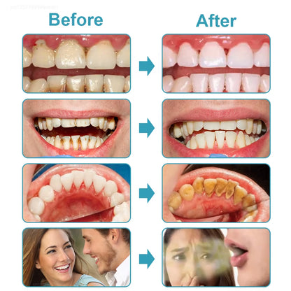 Tartar Remover Electric Powerful Ultrasonic Plaque Stain Remover for Teeth 2 In1 Ultrasonic Tooth Cleaning and Oral Irrigator